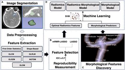 Classifying Ruptured Middle Cerebral Artery Aneurysms With a Machine Learning Based, Radiomics-Morphological Model: A Multicentral Study